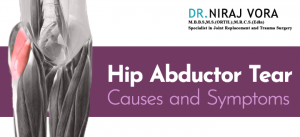 Hip Abductor Tear Causes and Symptoms | Dr Niraj Vora